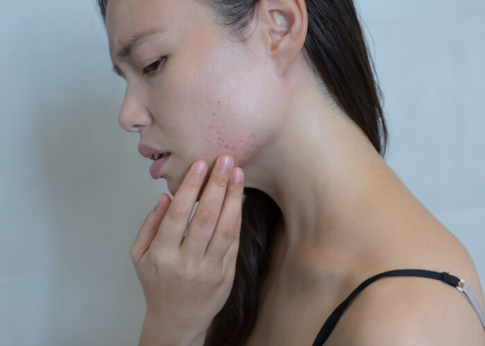 Pregnancy Acne: What Causes It, How To Alleviate It